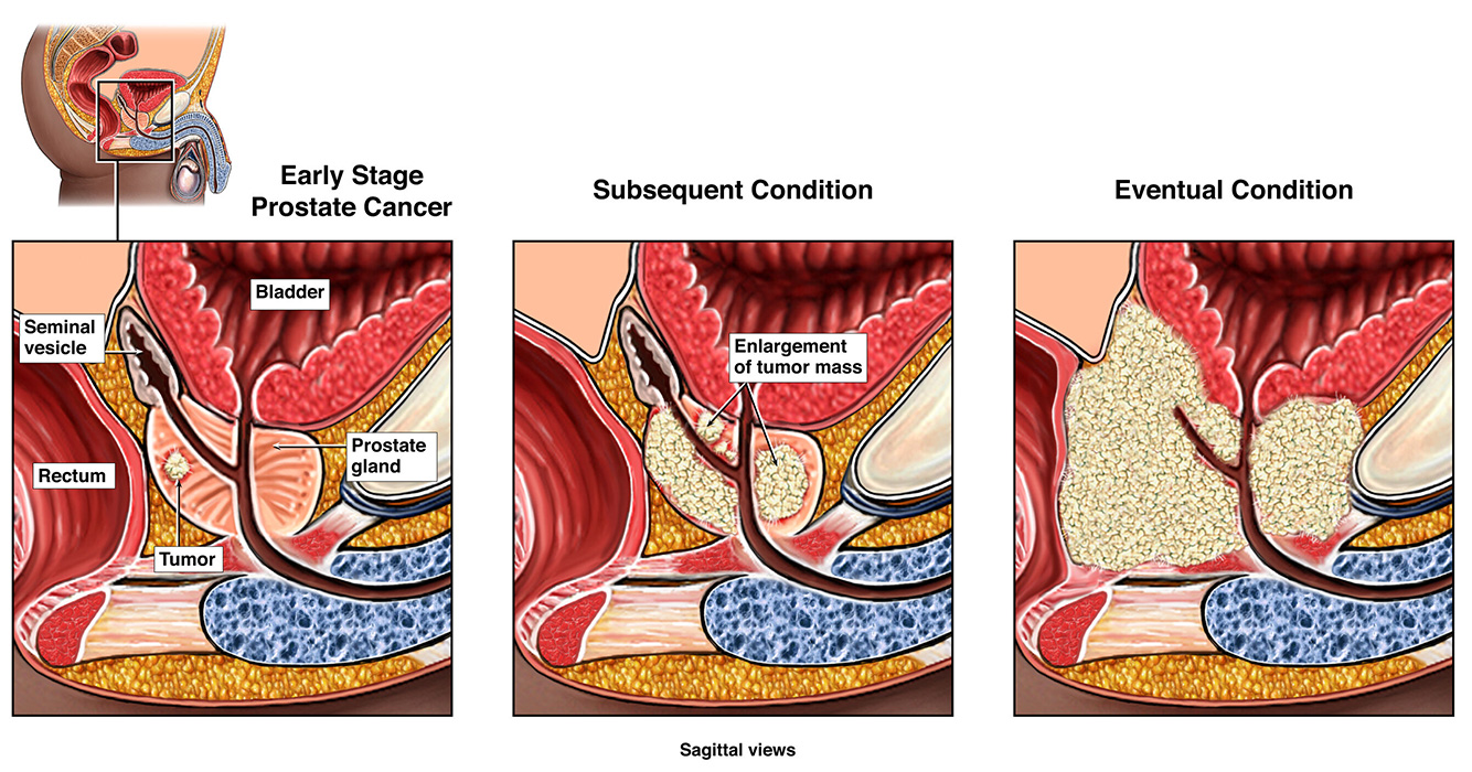 Prostate Cancer Causes Risk Factors and Prevalence